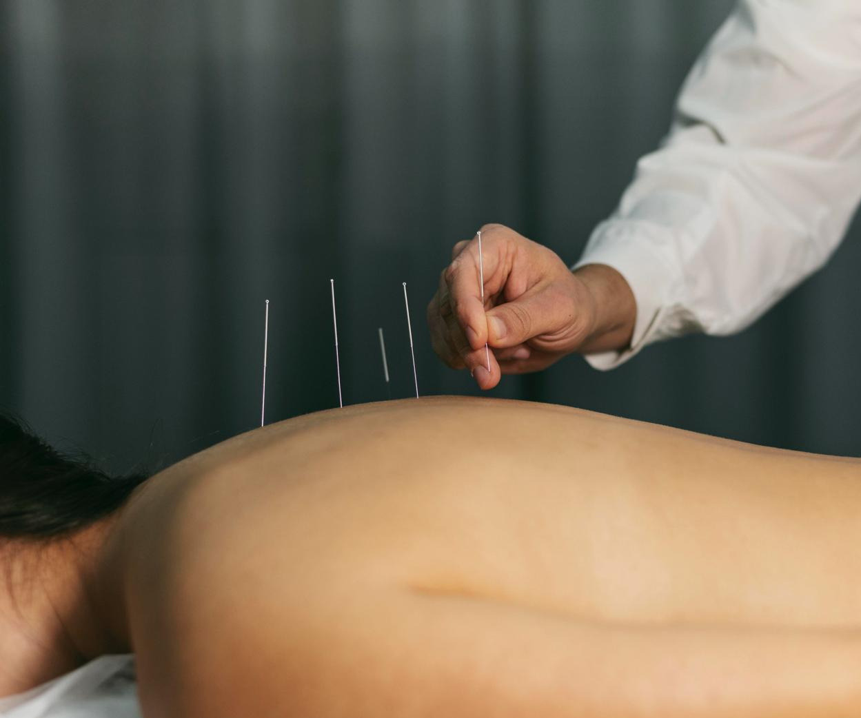 Acupuncture treatment